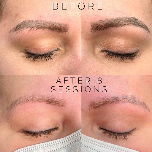 ریموو تاتو در تبریز