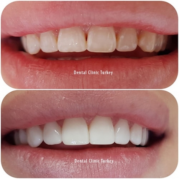 مزایا و معایب کامپوزیت دندان | لیست دندانپزشکان تبریز