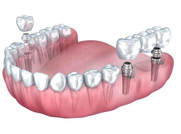 ایمپلنت دندان در تبریز