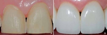 تفاوت کامپوزیت دندان و لمینت سرامیکی چیست؟ | شماره دندانپزشکان تبریز