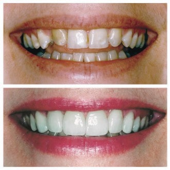 ناگفته های کامپوزیت دندان + لیست دندانپزشکان تبریز