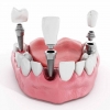 همه چیز درباره ی ایمپلنت دندان + قیمت ایمپلنت دندان | لیست دندانپزشکان تبریز